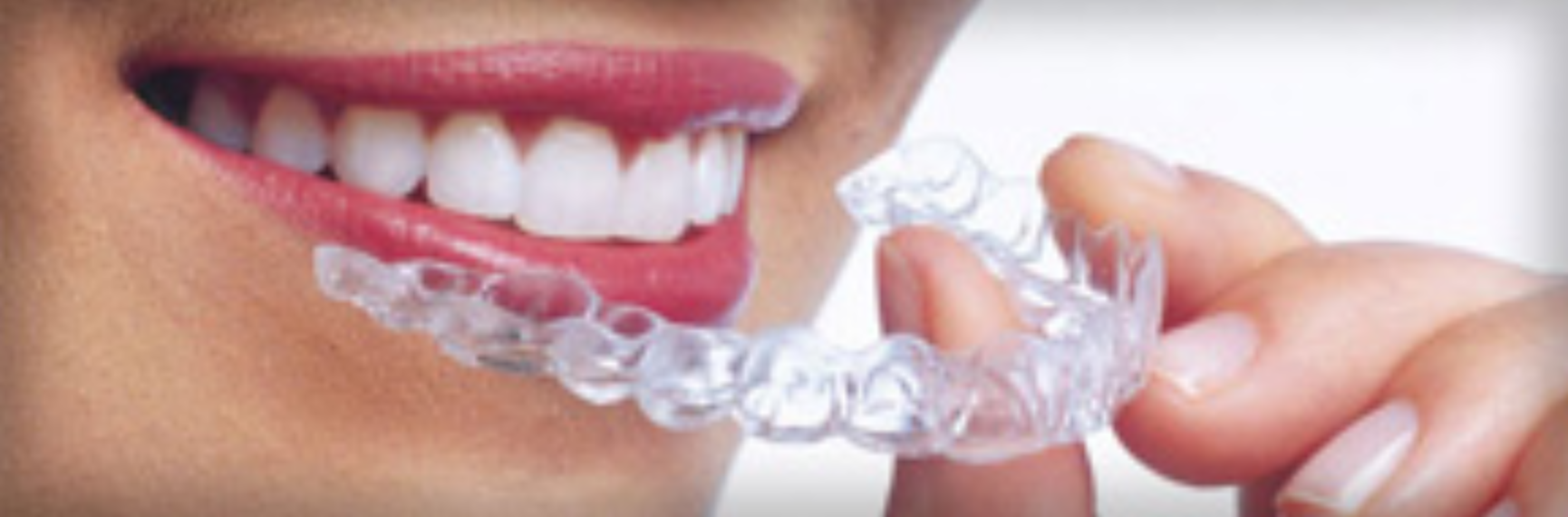 Aligners, Invisalign
