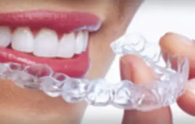 Aligners, Invisalign